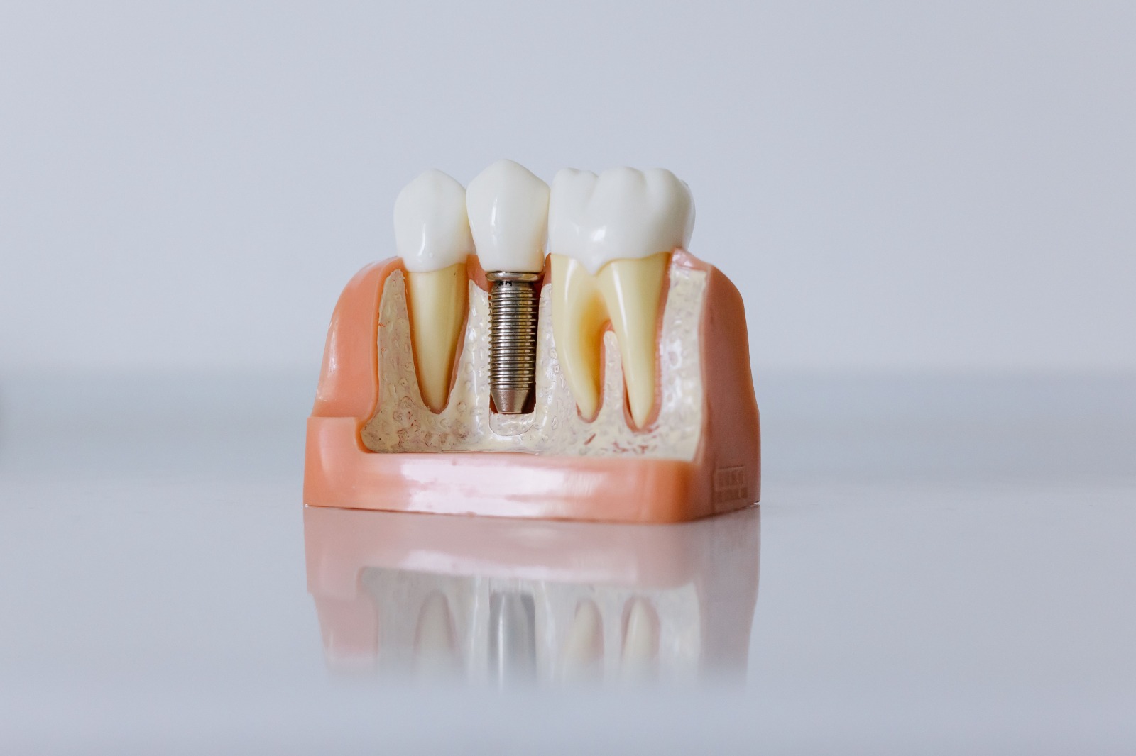 Dental implant procedure in progress